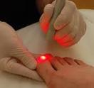 Toenail Fungus Laser